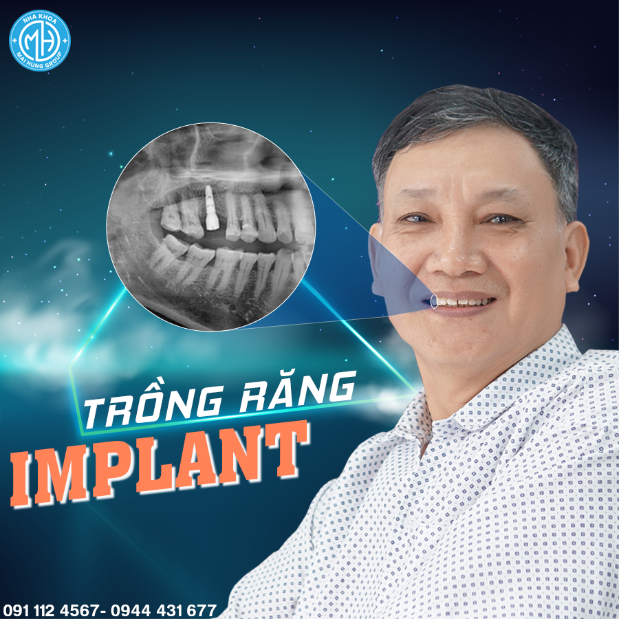 trong-rang-implant